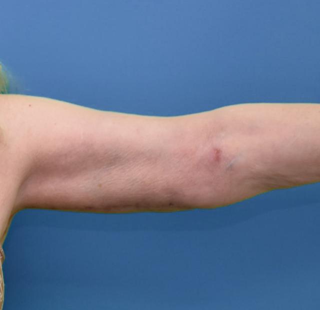 Arm Lift after at Neal Goldberg, MD in Scarsdale, NY