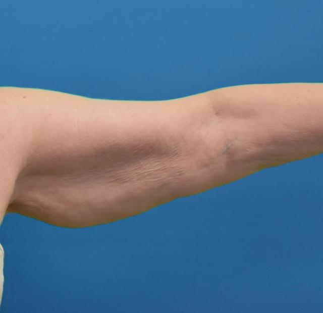 Arm Lift before at Neal Goldberg, MD in Scarsdale, NY