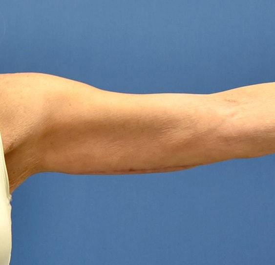 Arm Lift after at Neal Goldberg, MD in Scarsdale, NY