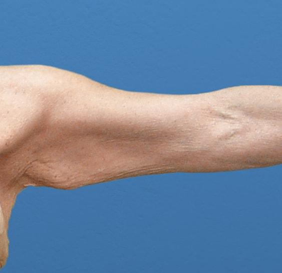 Arm Lift before at Neal Goldberg, MD in Scarsdale, NY