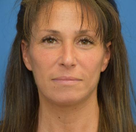 Facelift after at Neal Goldberg, MD in Scarsdale, NY