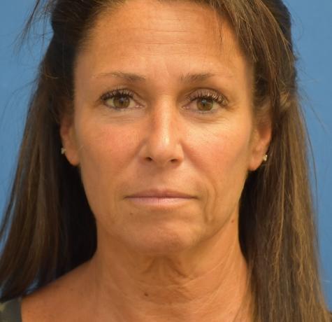 Facelift before at Neal Goldberg, MD in Scarsdale, NY