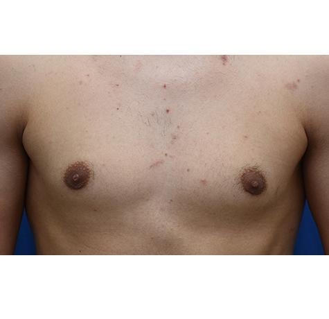 Neal Goldberg, MD gynecomastia after — Scarsdale, NY