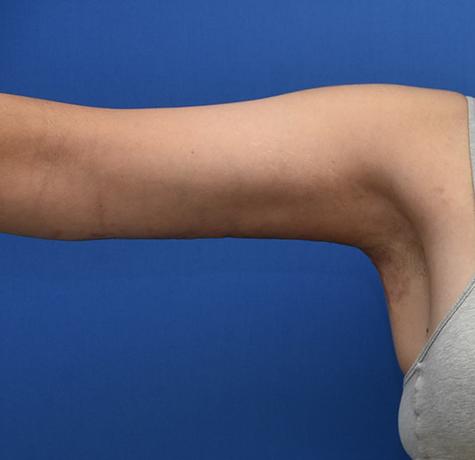 Arm Lift after at Neal Goldberg, MD in Scarsdale, NY