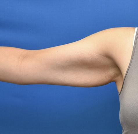 Arm Lift before at Neal Goldberg, MD in Scarsdale, NY
