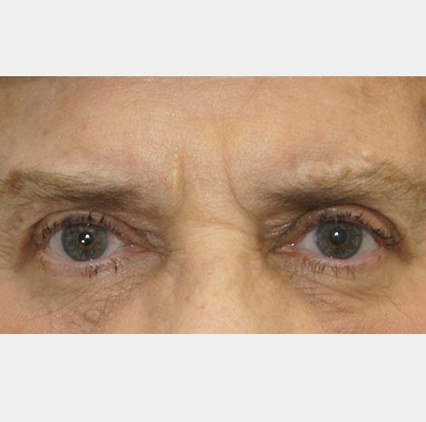 Brow Lift after at Neal Goldberg, MD in Scarsdale, NY