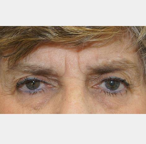 Brow Lift before at Neal Goldberg, MD in Scarsdale, NY