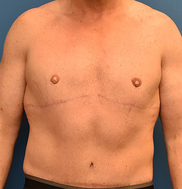 Neal Goldberg, MD tummy tuck after — Scarsdale, NY