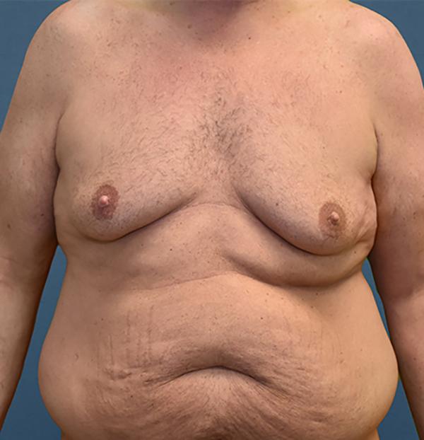 Mommy Makeover before at Neal Goldberg, MD in Scarsdale, NY