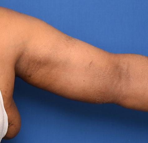 Arm Lift after at Neal Goldberg, MD in Scarsdale, NY