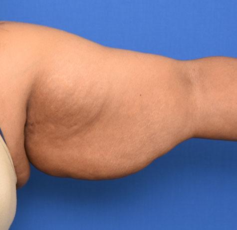 Arm Lift before at Neal Goldberg, MD in Scarsdale, NY