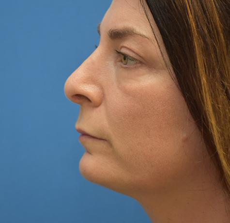 Neal Goldberg, MD rhinoplasty after — Scarsdale, NY