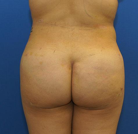 Liquid BBL after at Neal Goldberg, MD in Scarsdale, NY