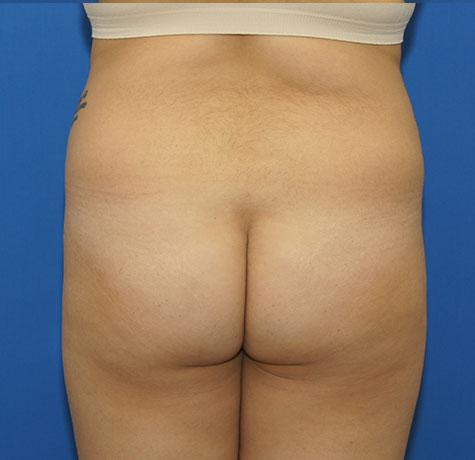 Liquid BBL before at Neal Goldberg, MD in Scarsdale, NY