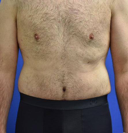 Neal Goldberg, MD tummy tuck after — Scarsdale, NY