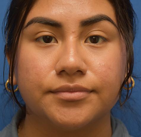 Neal Goldberg, MD rhinoplasty after — Scarsdale, NY