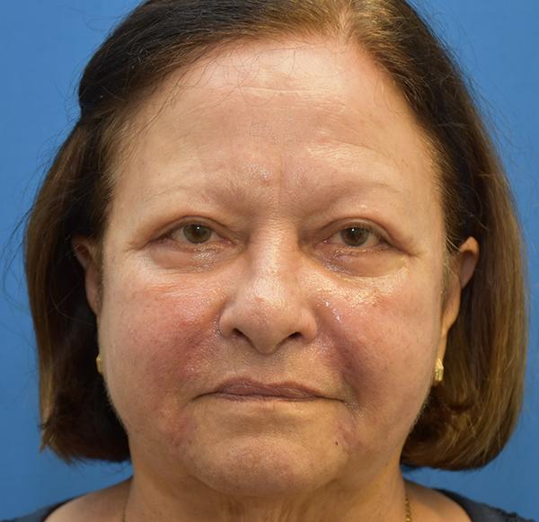 Neal Goldberg, MD blepharoplasty after — Scarsdale, NY