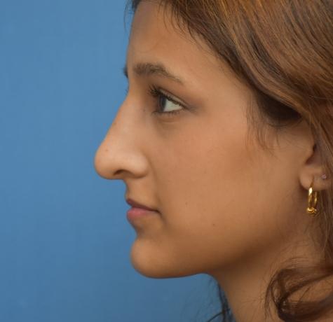 Functional Rhinoplasty after at Neal Goldberg, MD in Scarsdale, NY