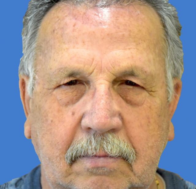 Blepharoplasty before at Neal Goldberg, MD in Scarsdale, NY