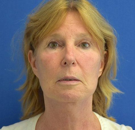 Neck Lift after at Neal Goldberg, MD in Scarsdale, NY