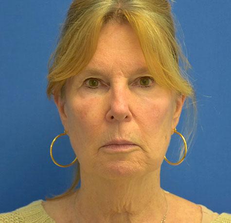 Neck Lift before at Neal Goldberg, MD in Scarsdale, NY