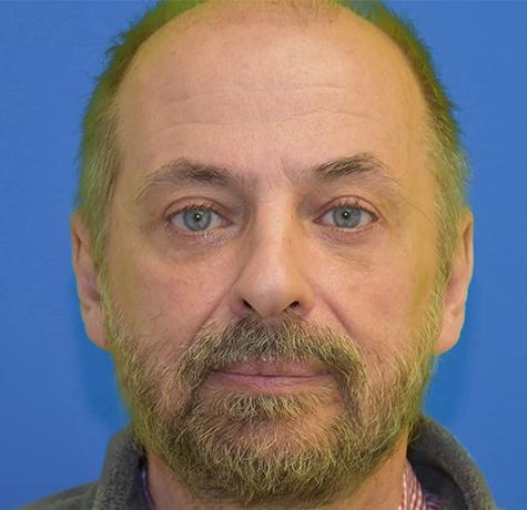 Neal Goldberg, MD blepharoplasty after — Scarsdale, NY