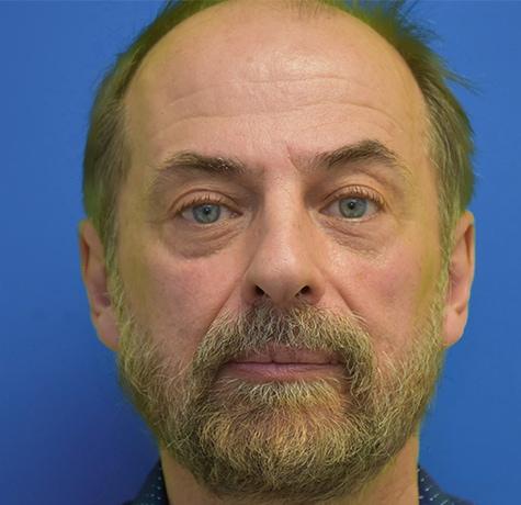 Blepharoplasty before at Neal Goldberg, MD in Scarsdale, NY