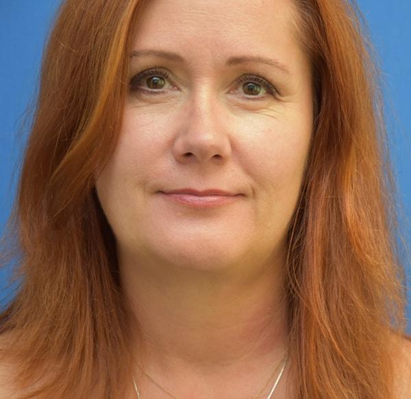 Chin Implant after at Neal Goldberg, MD in Scarsdale, NY