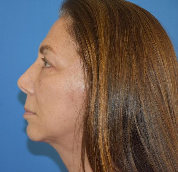 Neck Lift after at Neal Goldberg, MD in Scarsdale, NY
