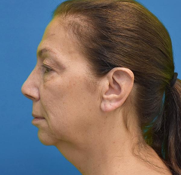 Neck Lift before at Neal Goldberg, MD in Scarsdale, NY
