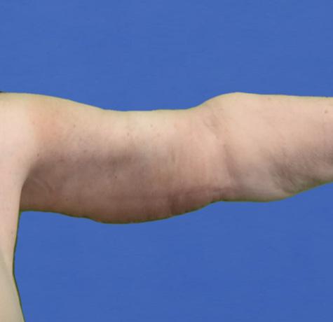 Arm Lift after at Neal Goldberg, MD in Scarsdale, NY