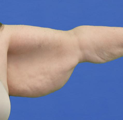 Arm Lift before at Neal Goldberg, MD in Scarsdale, NY