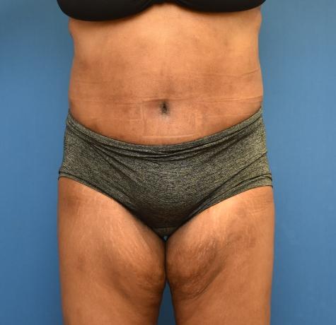 Tummy Tuck after at Neal Goldberg, MD in Scarsdale, NY