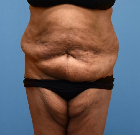 Tummy Tuck before at Neal Goldberg, MD in Scarsdale, NY