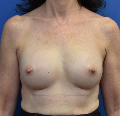 Breast Augmentation after at Neal Goldberg, MD in Scarsdale, NY