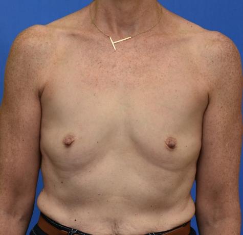 Breast Augmentation before at Neal Goldberg, MD in Scarsdale, NY
