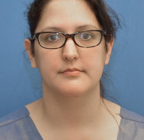Liposuction before at Neal Goldberg, MD in Scarsdale, NY