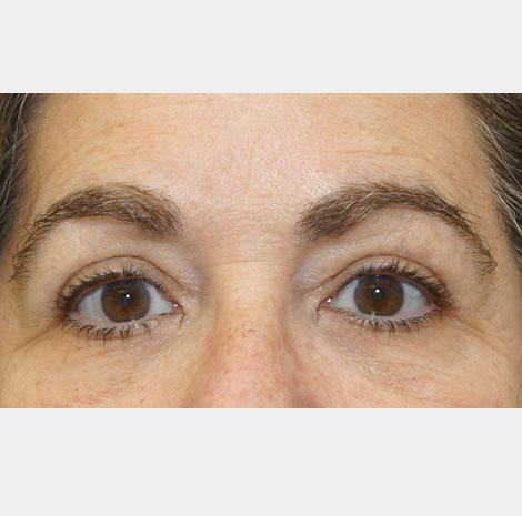 Brow Lift after at Neal Goldberg, MD in Scarsdale, NY