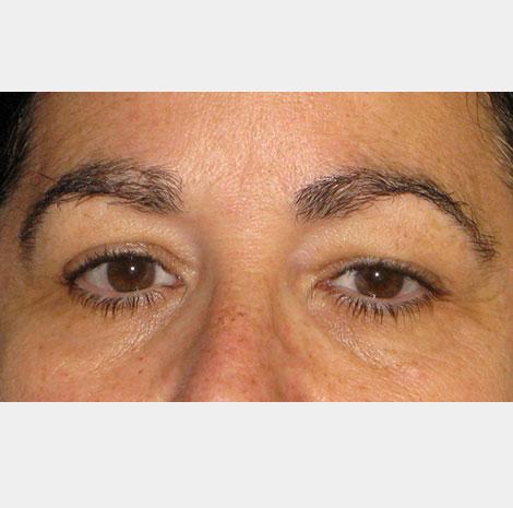 Brow Lift before at Neal Goldberg, MD in Scarsdale, NY