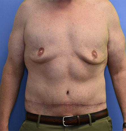 Neal Goldberg, MD tummy tuck after — Scarsdale, NY