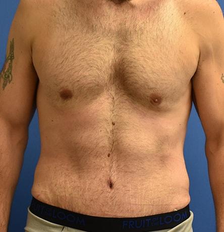 Neal Goldberg, MD tummy tuck after — Scarsdale, NY