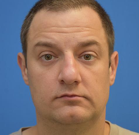 Neal Goldberg, MD blepharoplasty after — Scarsdale, NY