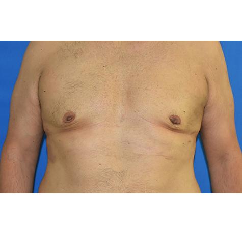 Neal Goldberg, MD gynecomastia after — Scarsdale, NY