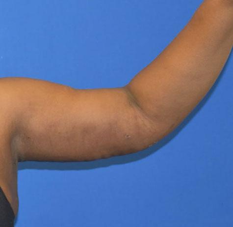 Arm Lift after at Neal Goldberg, MD in Scarsdale, NY