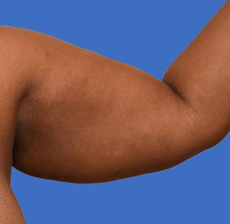 Arm Lift before at Neal Goldberg, MD in Scarsdale, NY