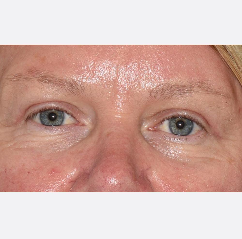 Neal Goldberg, MD brow lift after — Scarsdale, NY