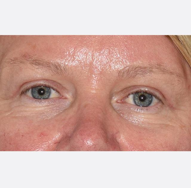 Brow Lift after at Neal Goldberg, MD in Scarsdale, NY