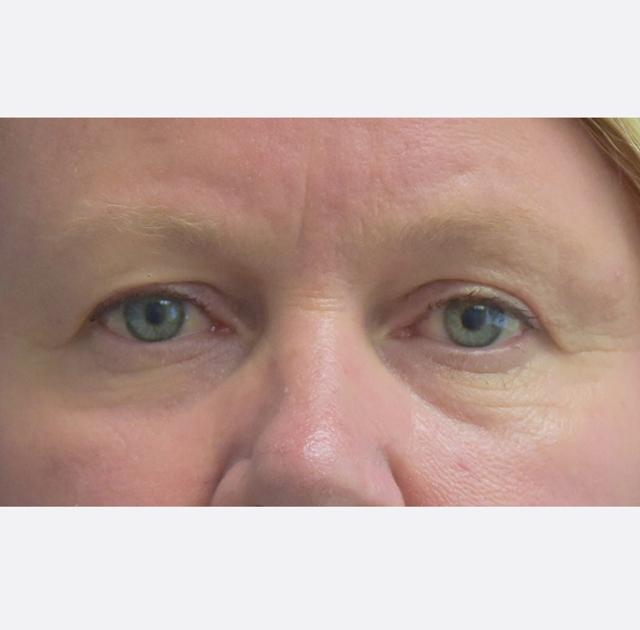 Brow Lift before at Neal Goldberg, MD in Scarsdale, NY