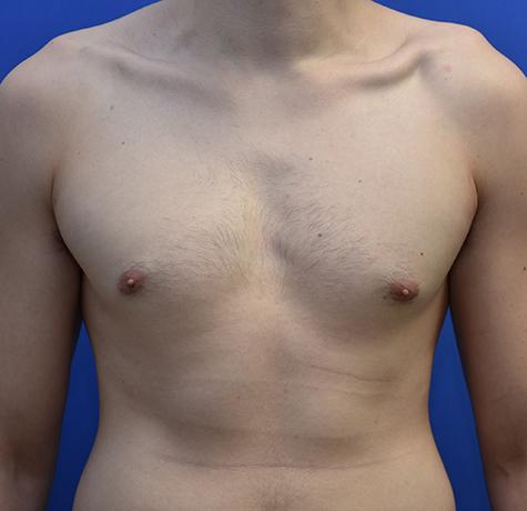 Neal Goldberg, MD gynecomastia after — Scarsdale, NY