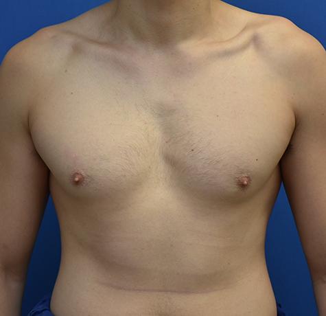 Gynecomastia Surgery before at Neal Goldberg, MD in Scarsdale, NY